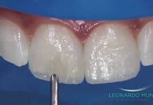 Aumento Incisal con Resinas Compuestas