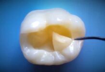 Como hacer la restauracion de una Clase 1 con composite dental paso a paso